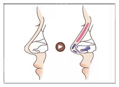 自体软骨移植隆鼻术