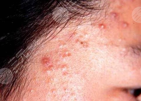 丘疹性痤疮引起的因素