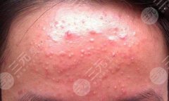 丘疹性痤疮怎么缓解？丘疹性痤疮会自己好吗？