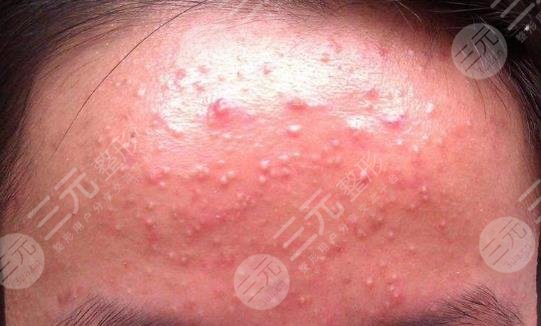 丘疹性痤疮怎么缓解？丘疹性痤疮会自己好吗？