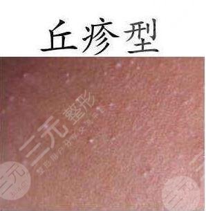 丘疹性痤疮怎么缓解