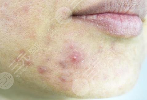 激光祛痤疮原理