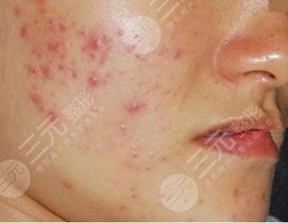 激光祛痤疮的果