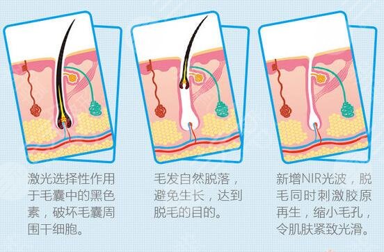 小腿激光脱毛价格多少钱？夏天get滑溜美腿，先把“毛衣”脱掉！