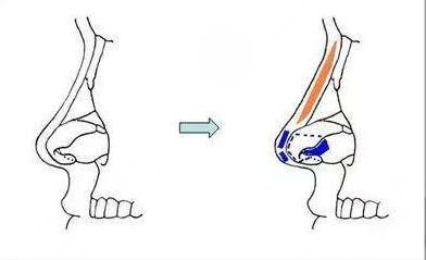隆鼻手术的原理是什么