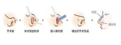 假体隆鼻的价格