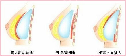 麦格娜绮丽假体多少钱