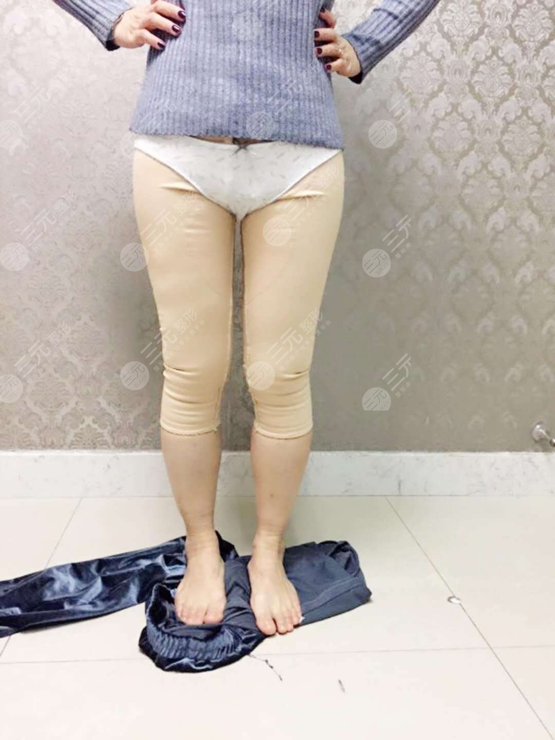 2021新价格表&吸脂瘦腿图公开!