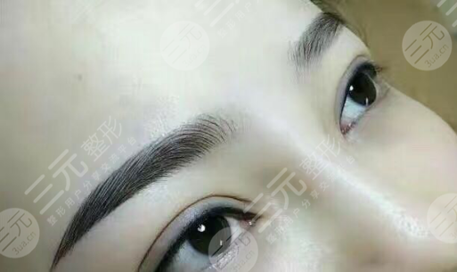 眉毛种植手术的成好吗