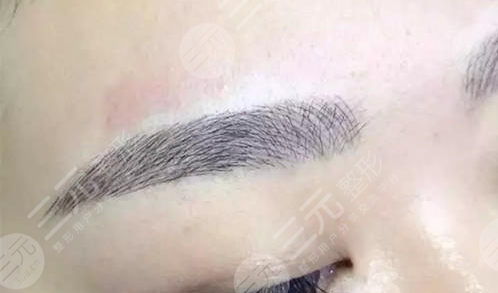 植眉毛多久能恢复正常