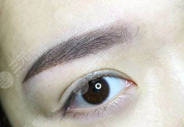植眉毛手术恢复时间