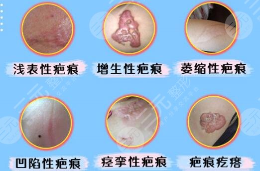 祛痘除疤手术多少钱？点阵激光帮你搞定，科普讲解看看！