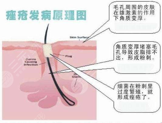 点阵激光去痘疤的原理