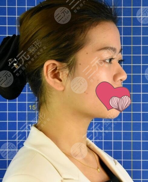 王海平医生做鼻子前