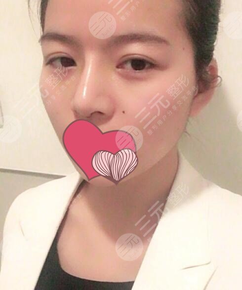 王海平医生做鼻子术后半个月