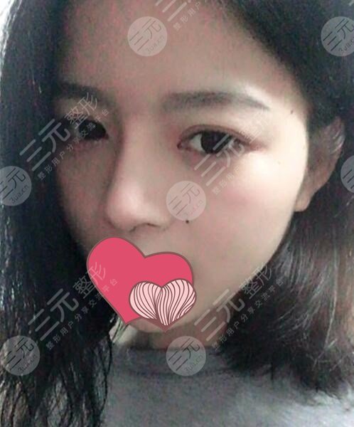 王海平医生做鼻子术后1个月