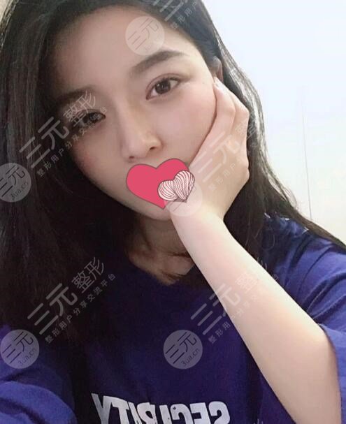 王海平医生做鼻子术后3个月