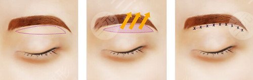 提眉术价格一般是多少