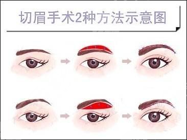 提眉术价格一般是多少