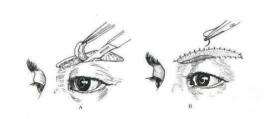提眉术价格一般是多少