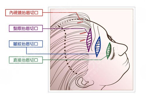 提眉术价格一般是多少