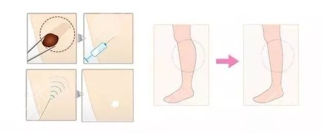 脂肪减少瘦小腿