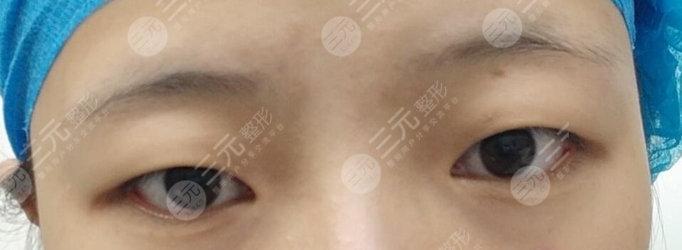 施越冬割双眼皮案例