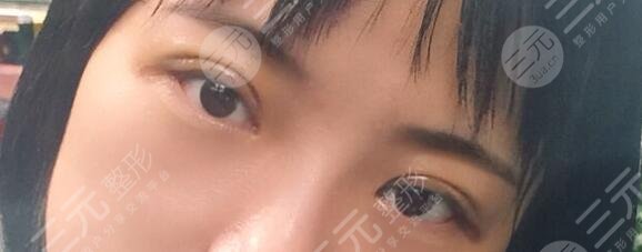 施越冬割双眼皮案例