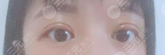 施越冬割双眼皮