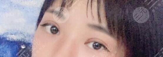 施越冬割双眼皮