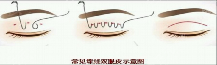 埋线双眼皮