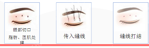 三点定位双眼皮