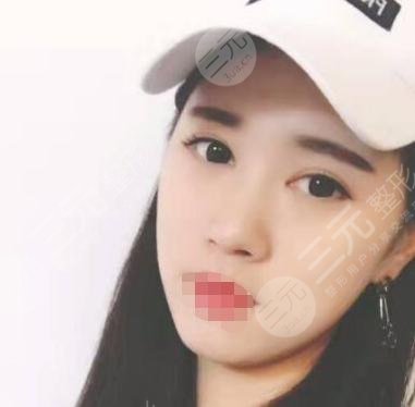 开眼角整形后6周