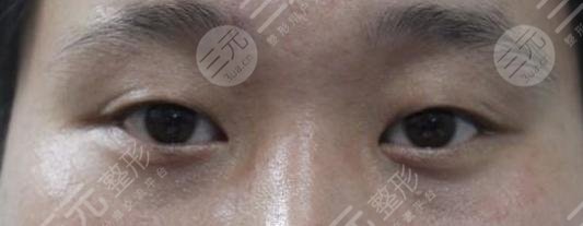 眼睛距离过近的人不适合开眼角