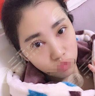 开眼角整形后一周
