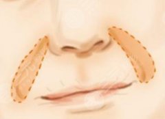 自体脂肪填充鼻唇沟多久吸收？注射填充的注意事项你都了解了么？
