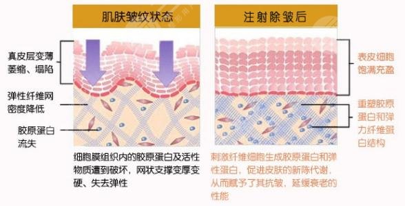 注射除皱降低风险吗？适用部位&注意事项科普，特点介绍！