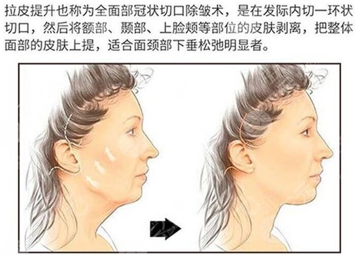 大拉皮除皱