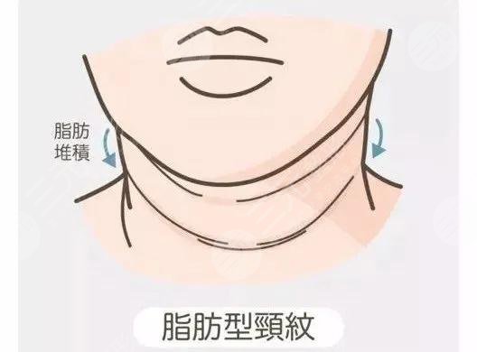 颈纹