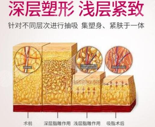 激光溶脂瘦腿