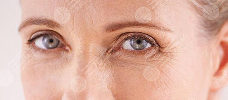 面部除皱|鱼尾纹怎么去除？让心灵之窗绽放“睛”彩