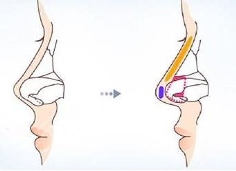 畸形鼻部整形要多少钱