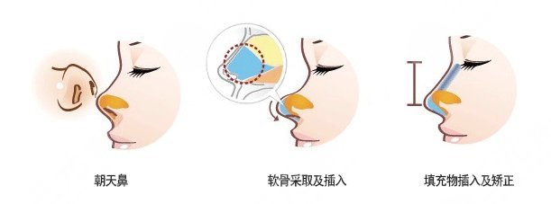 畸形鼻部整形要多少钱