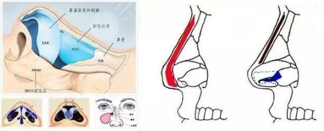 畸形鼻部整形要多少钱