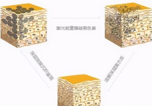 点阵激光祛痘坑果怎么样？别再涂涂抹抹，医美帮你搞定！