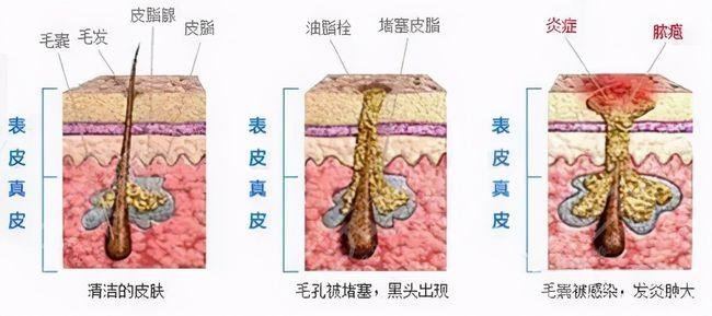 点阵激光祛痘坑