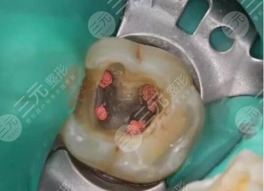 牙髓炎根管治疗费用丨治疗步骤图丨治疗过程一览,慎点!-三元整形网