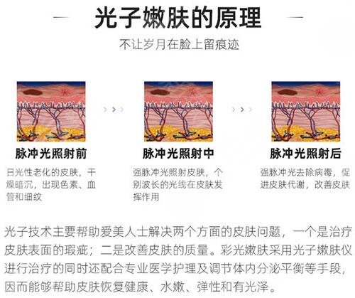 光子嫩肤