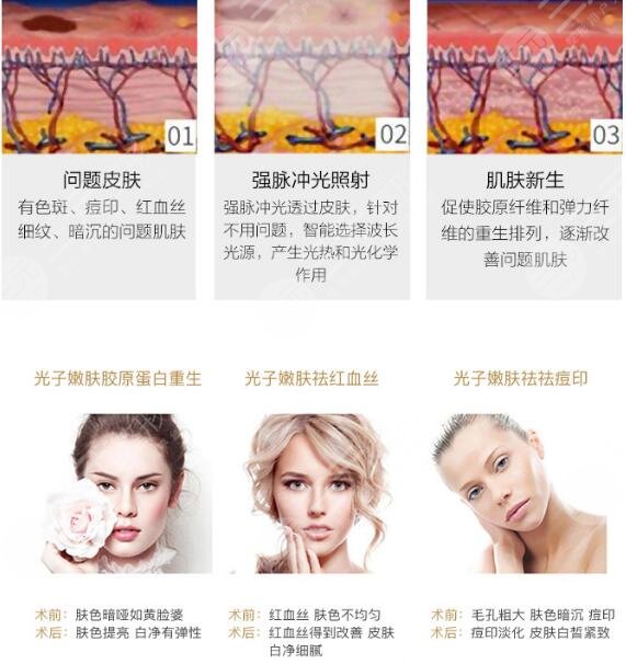 光子嫩肤手术的过程