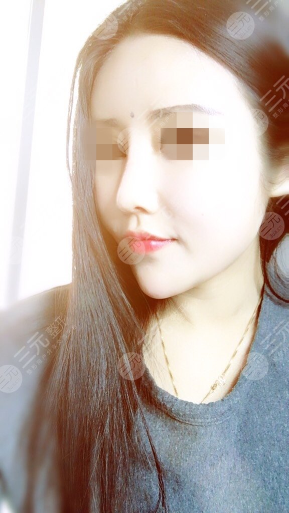 医生口碑介绍 歪鼻手术矫正效果-三元整形网